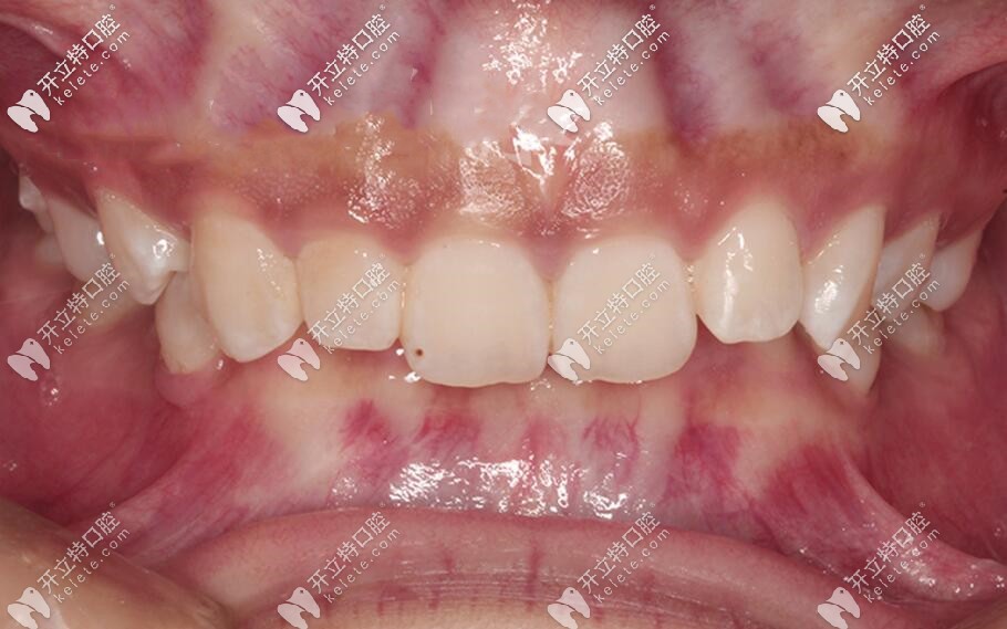 三度深覆合照片 三度深覆合照片