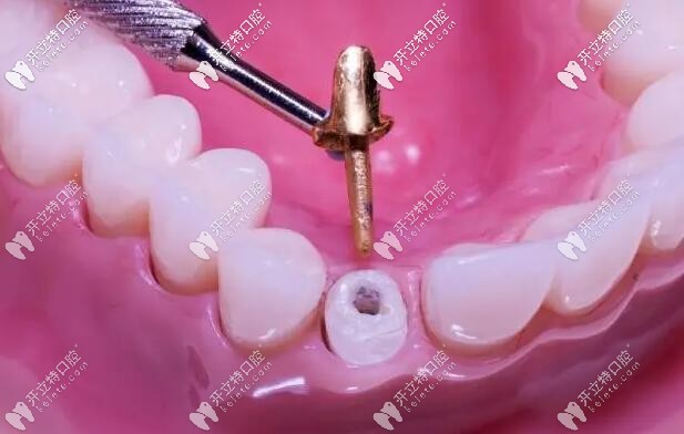 純鈦和纖維牙樁哪個好,做后牙修復(fù)的時候有什么區(qū)別嗎