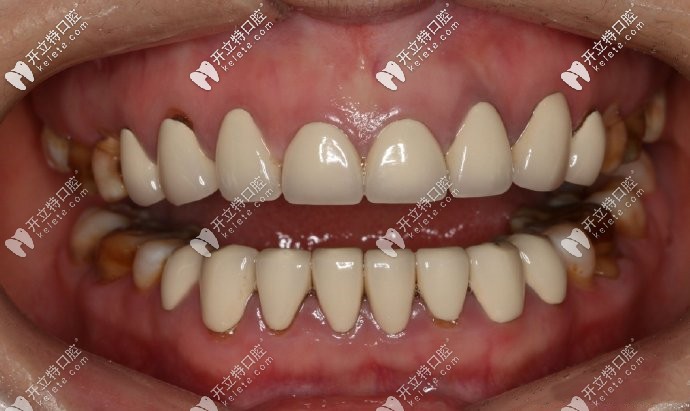 在小診所做的全瓷牙，死白，沒有一點美感可言