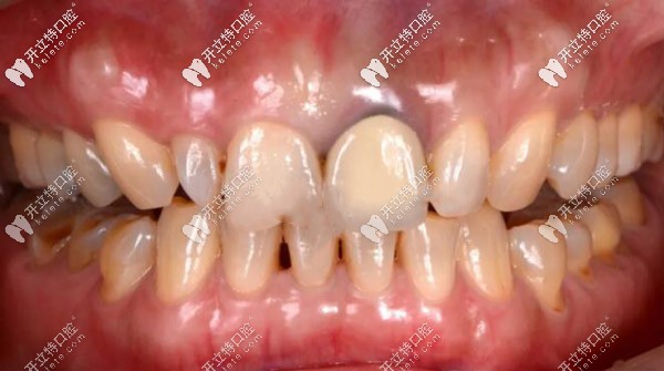 國產(chǎn)的愛爾創(chuàng)全瓷混合型頜貼面成功修復(fù)齲齒案例賞析
