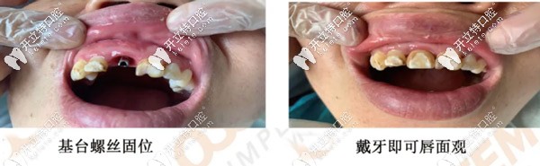 修復(fù)后與原牙色澤想同