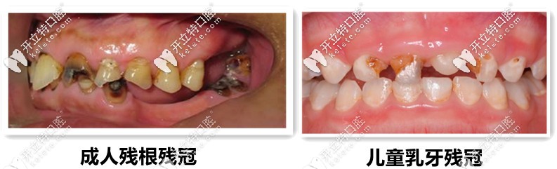 殘根殘冠拔除、兒童乳牙的殘冠等癥狀圖