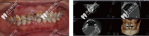 上頜前牙即拔即種聯(lián)合鈦網(wǎng)固定骨粉,采用OsstemTS 3.5*13植體
