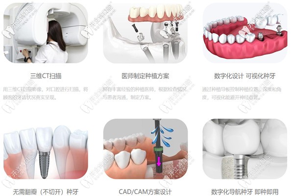 微創(chuàng)種植牙的過程