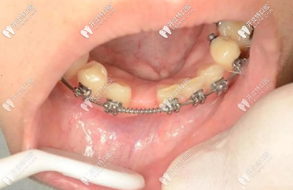 正畸和種植可以同時進行嗎