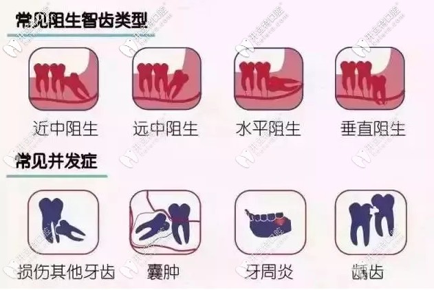 阻生智齒的危害