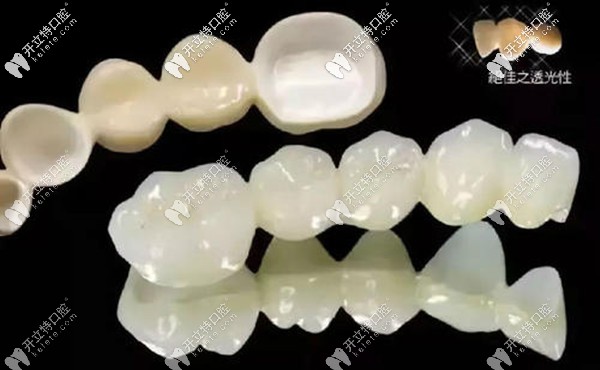 深圳格倫菲爾威蘭德全瓷牙的價格