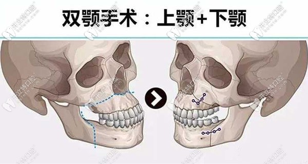 <!--<i data=20240703-sp></i>-->做骨性地包天矯正的費(fèi)用是多少？