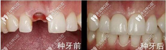 美奧口腔張書(shū)桓種植牙案例一