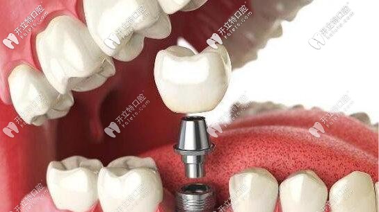 瑞典諾貝爾pmc種植體為什么便宜