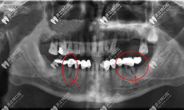 單端固定橋的缺點(diǎn)和禁忌癥你知道嗎?別做了牙才后悔