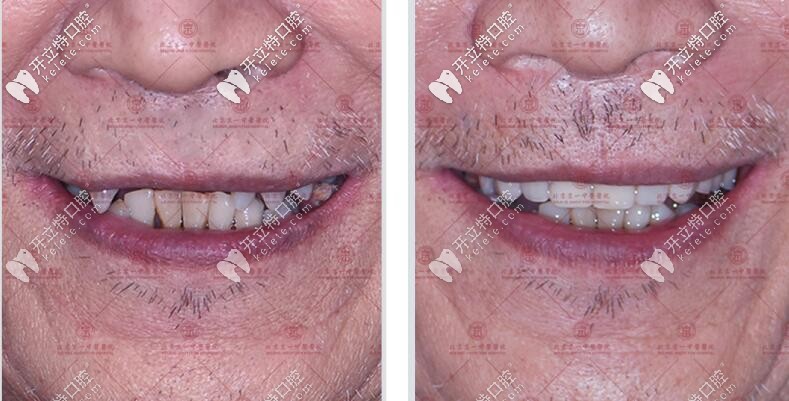 種4顆半口種植牙的效果對(duì)比