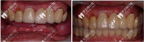 美奧口腔張書(shū)桓種植牙案例二