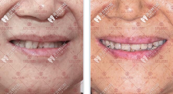 北京京一做4顆半口種植牙圖片合集,傳統(tǒng)種植和即刻用都有