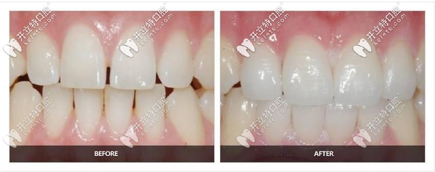 美萊口腔：黃麗瓊醫(yī)生—牙貼面修復案例