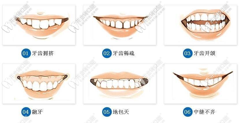 牙齒矯正的適應癥狀