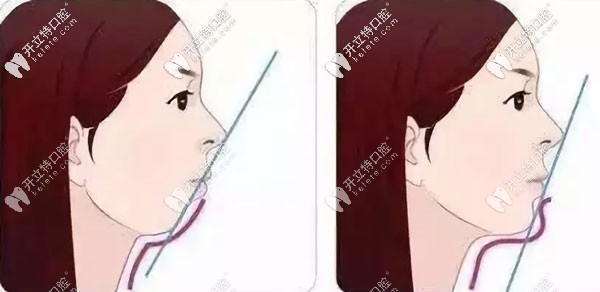 小孩子下巴后縮,通過正畸導(dǎo)下頜向前的較佳年齡是幾歲？