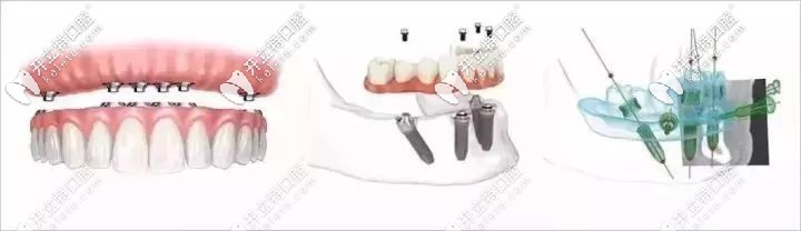 全口種植的方式