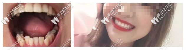 揭陽華美口腔真人案例