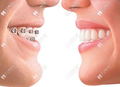 聽說濮陽矯正牙齒比較好的醫(yī)院是這兩家,還有正畸價格表哦