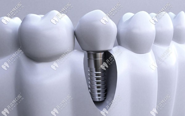 韓國登騰Dentium種植體的優(yōu)點