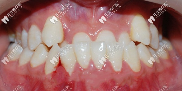 重度骨性牙頜畸形做掩飾性正畸的效果不會很理想