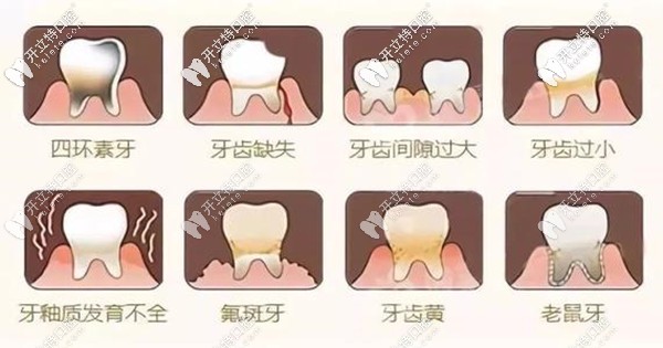 合肥貝杰口腔全瓷貼面修復(fù)的優(yōu)點(diǎn)