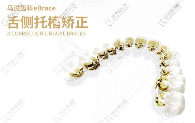 ebrace舌側(cè)隱形矯正