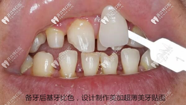 備牙后基牙比色，設(shè)計(jì)制作美加超薄美牙貼面