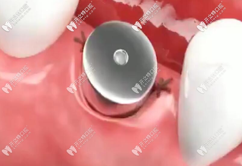 安裝愈合基臺，縫合傷