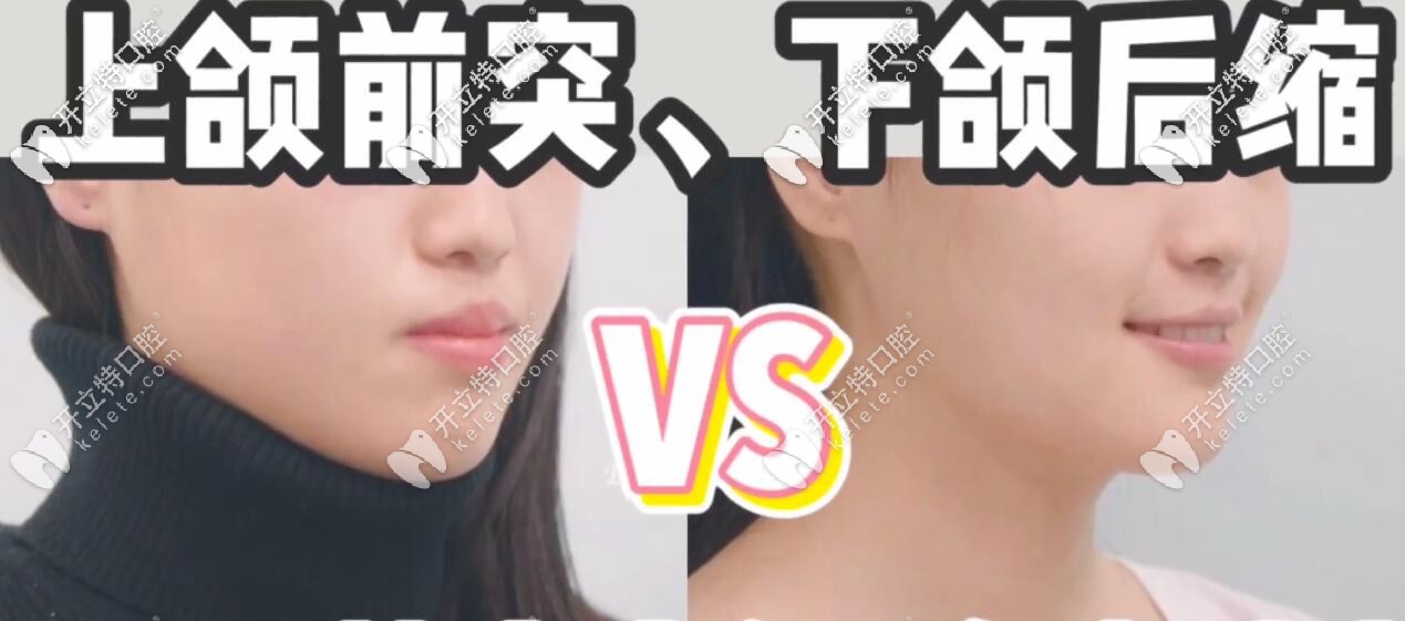 嘴巴前突矯正前后側(cè)臉效果對比