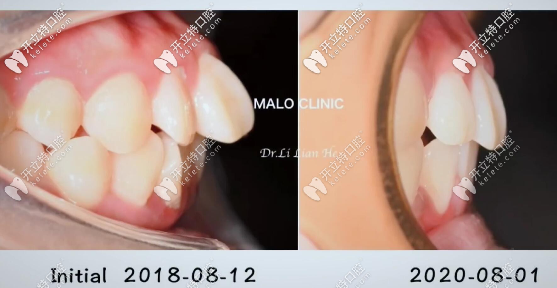 左圖為矯正前，牙齒根部凸起像骨頭一樣