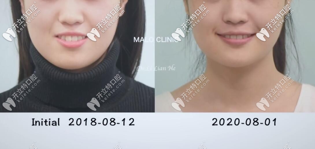 齙牙矯正前后我的臉型對比圖