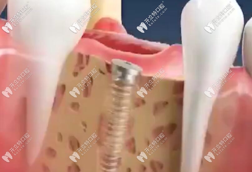 種植牙一期二期三期流程及時間詳解，詳細過程步驟見視頻