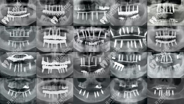 各類(lèi)全口種植牙的全景片展示圖