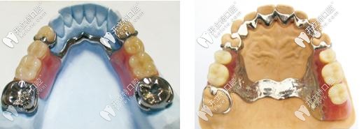 活動義齒牙托一般什么材質(zhì)好?談?wù)劶冣伜外伜辖鹧劳袇^(qū)別