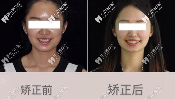 記錄我牙齒內(nèi)傾使用進口隱適美牙套矯正兩年的過程 