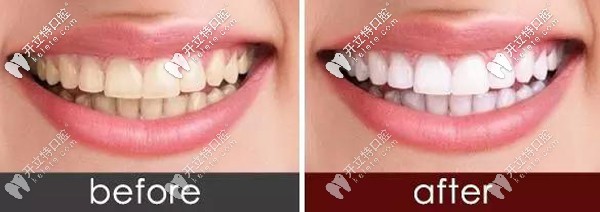 琥珀瓷牙貼面前后對比