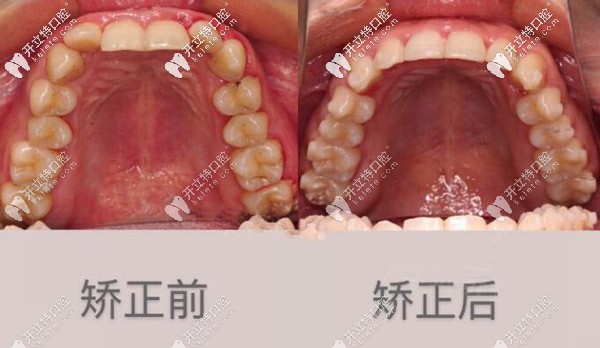 牙齒內傾 牙齒內傾