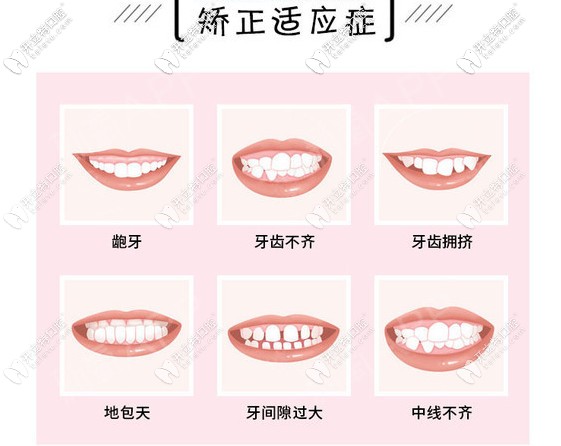 哪些牙齒要做牙齒矯正呢？請(qǐng)對(duì)號(hào)入座！