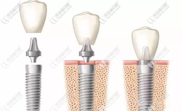 連續(xù)掉了三顆牙需要種植幾顆牙根