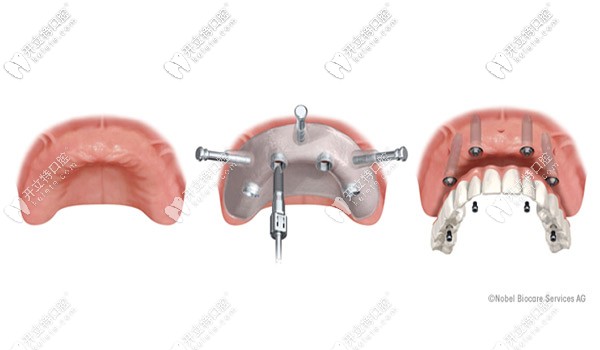 ALL-ON-4種植技術