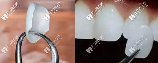 全瓷貼面種類(lèi)