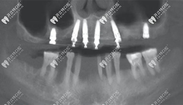點(diǎn)種6顆種植體