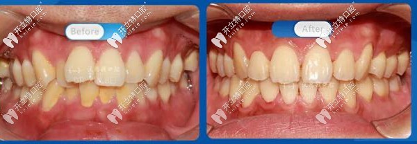牙齒骨性前凸and磨牙深覆蓋的我選擇在維樂口腔做托槽矯正