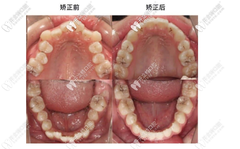 百適美矯正前后對(duì)比圖