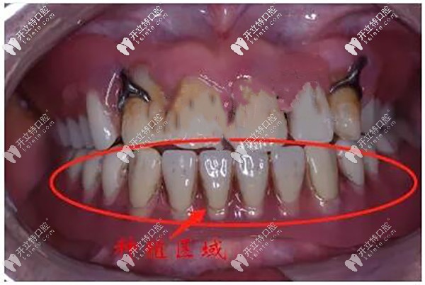 看看楊先生術(shù)后效果