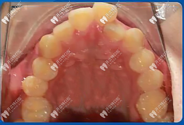 牙齒重度擁擠不齊，牙弓狹窄