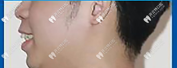 側(cè)面顯凸嘴，唇型厚重，唇肌緊張