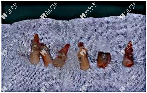 牙齒遺 留的殘根、松動牙齒拔除掉